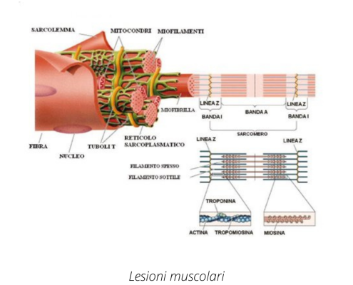 Lesioni muscolari 3